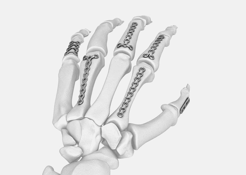 MICROLOCK® Locking Hand System