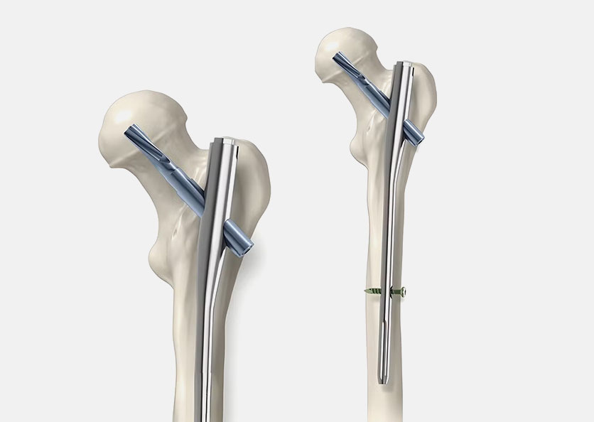 PROXAFIX® PFNA Nailing System