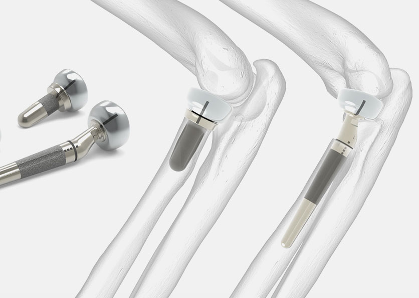 RADIALINK® Radial Head Prosthesis