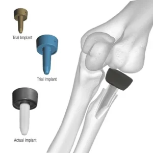 Radial Head Prosthesis