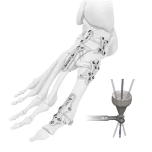 ANKLELOCK Variable Angle Forefoot & Midfoot 2.4/2.7 mm System