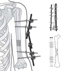 External Fixator System