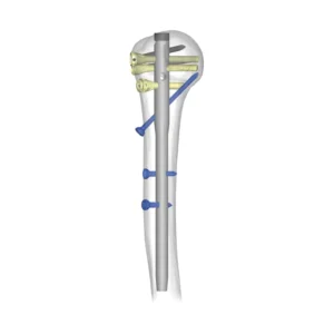 Humeron Multifix Humeral Nail