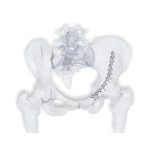 Low Profile Pelvis Plating System