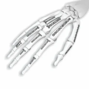 MicroLock Locking Hand System