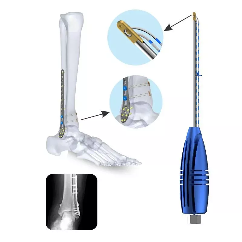 Flex Rope for Syndesmosis Repair, titanium – Sterile