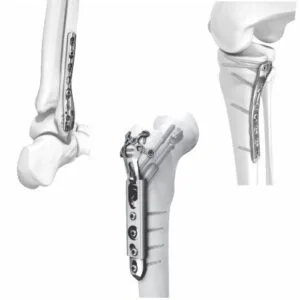 Helix Locking Plate System