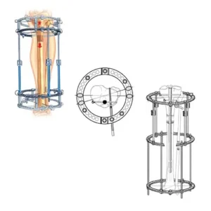 Ilizarc Ring Ex - Fix System